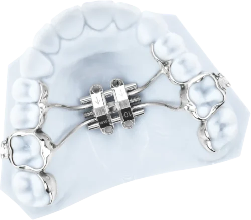 Expanders (Palatal Expanders)